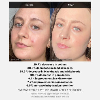 Medicube Red Acne Succinic Acid Peel | Peeling Serum 40g